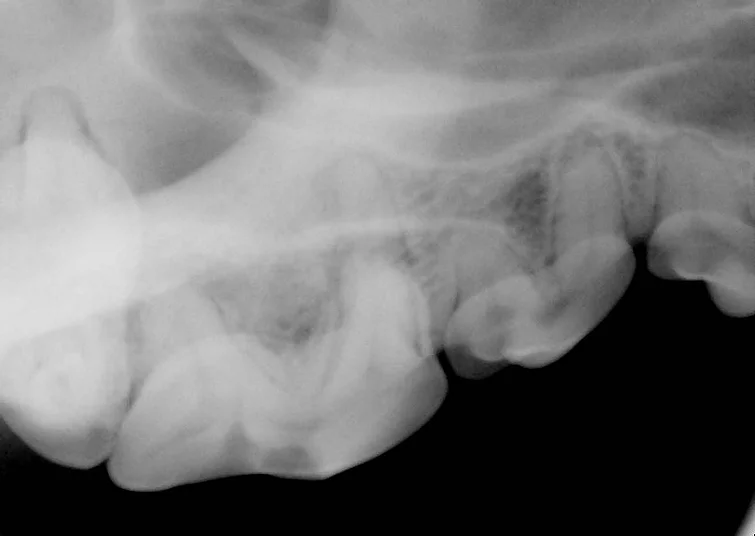 Case #029: 108 破折　抜髄根充による治療 | 歯科
